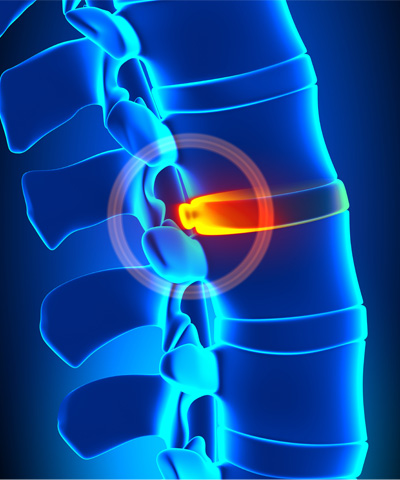 afbeelding Hernia afbeelding Hernia